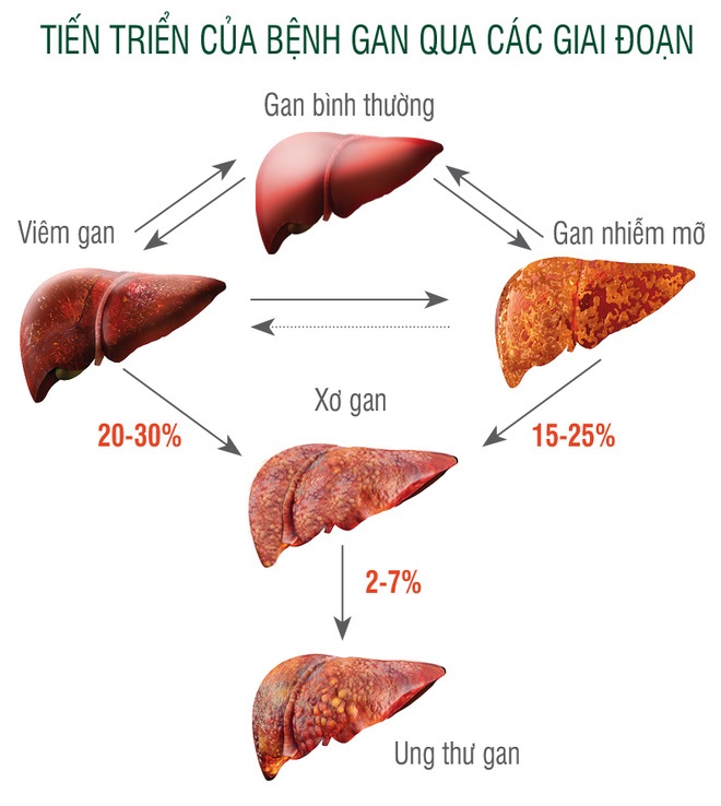 NHỮNG ĐIỀU CẦN BIẾT VỀ BỆNH LÝ XƠ GAN RƯỢU